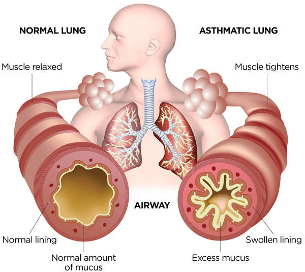 asthma8