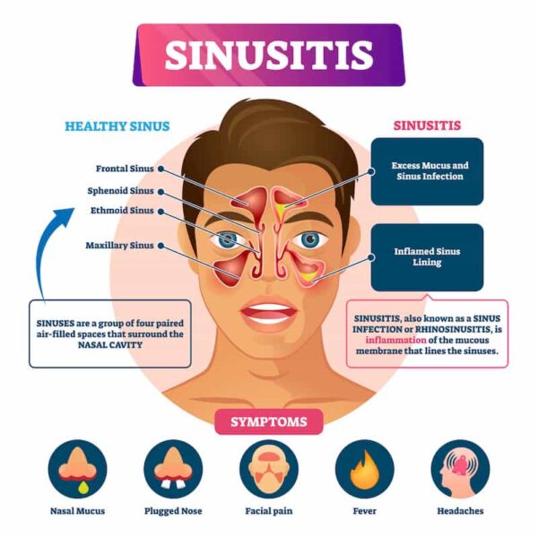 sinusitis-symptoms-600x600